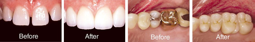 Dental treatment-Before and After